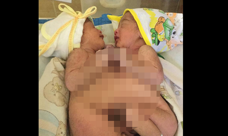 Bayi kembar dempet saat berada di ruang perinatologi level 2 RSUD Sultan Imanuddin Pangkalan Bun Kabupaten Kotawaringin Barat Minggu (5/1/2020)