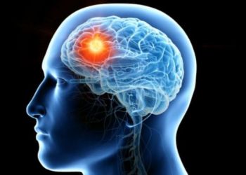 Kanker Otak Bisa Mengurangi Tingkat Kecerdasan